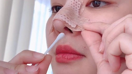 Nên vệ sinh mũi bằng nước muối sau nâng mũi để tránh nhiễm trùng
