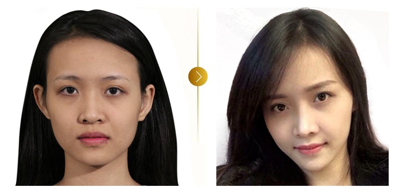 Trương Mỹ Nhân trước và sau khi được Tiến sĩ, Bác sĩ Shin Dong Min thực hiện nâng mũi S-line