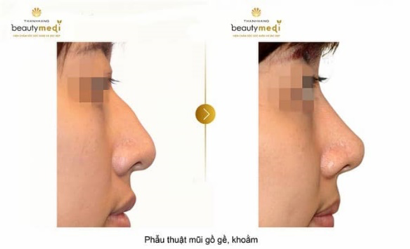 Khách hàng sau liệu trình nâng mũi gồ ghề