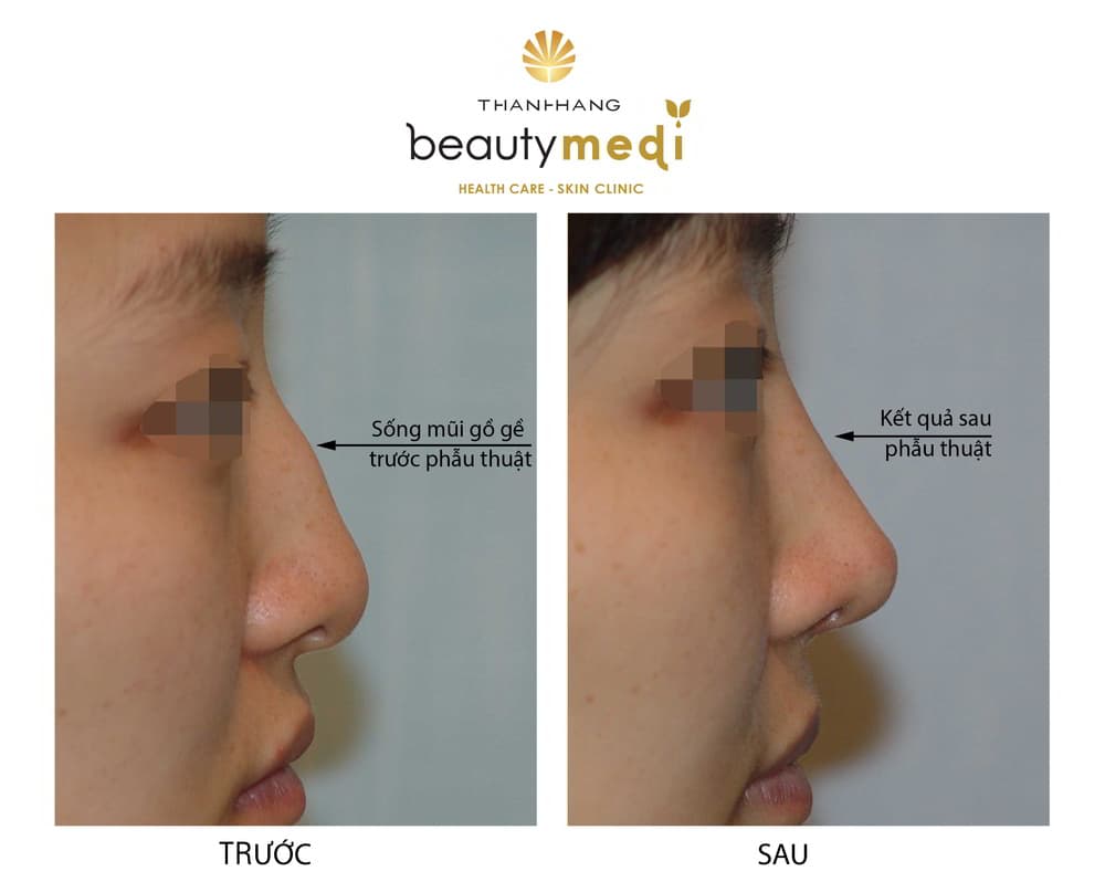 Hình ảnh thực tế trước và sau khi nâng mũi tại Thanh Hằng Beauty Medi