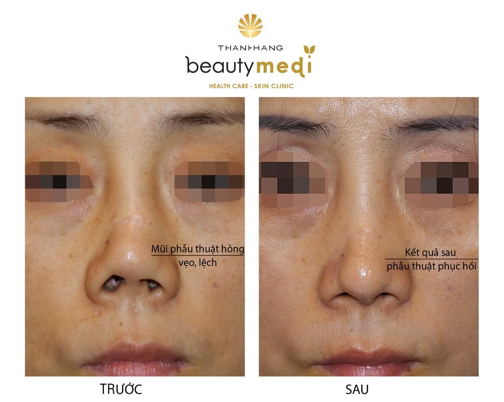 Hình ảnh thực tế trước và sau khi nâng mũi tại Thanh Hằng Beauty Medi