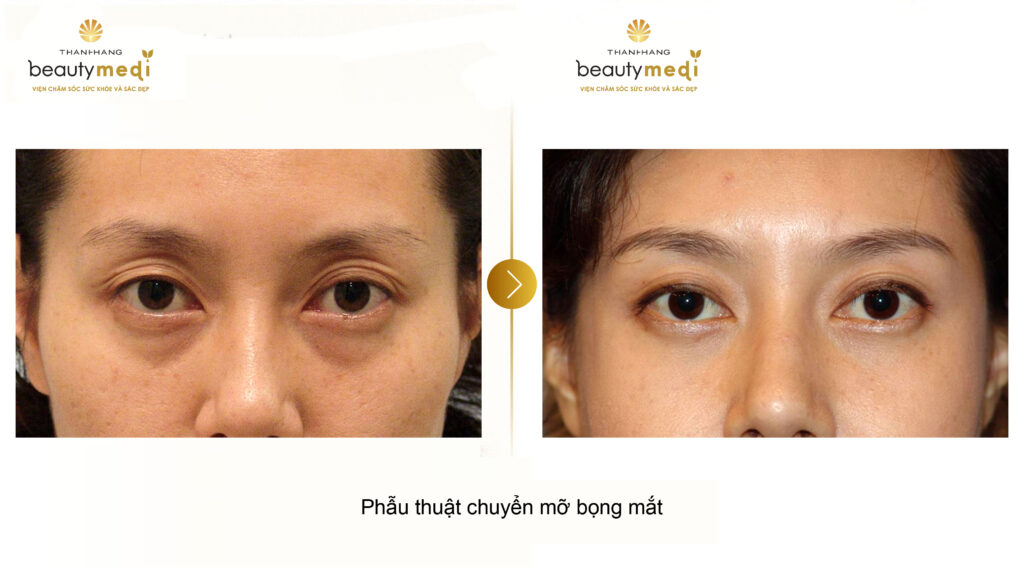 Hình ảnh trước vào sau khi lấy mỡ mí mắt