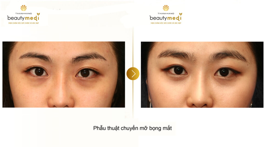 Thay đổi sau khi phẫu thuật lấy mỡ mí mắt