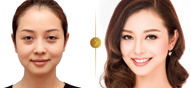 Jennifer Phạm trước và sau khi phẫu thuật thẩm mỹ mắt tại Thanh Hằng Beauty Medi
