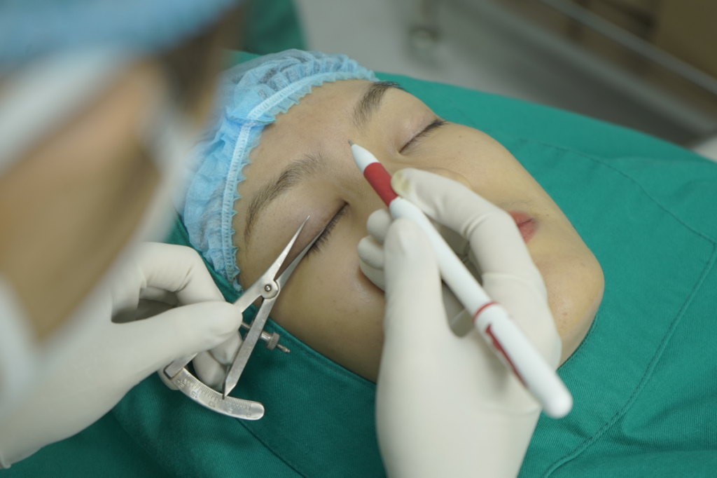 Bấm mí được sử dụng để khắc phục mắt mí lót