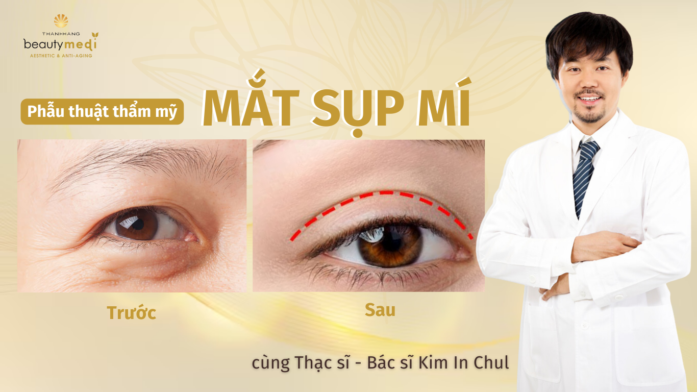 mắt sụp mí thumbnail