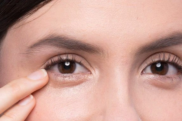 Phẫu thuật nâng cơ mí mắt giúp cải thiện tình trạng mỡ thừa và bọng mắt hiệu quả 