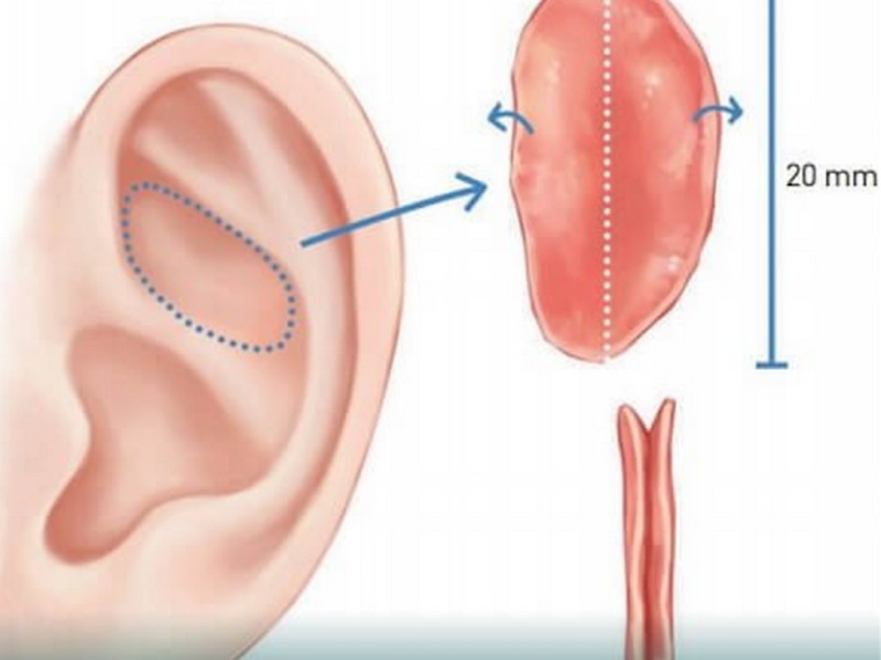 Sụn tai được sử dụng trong nâng mũi