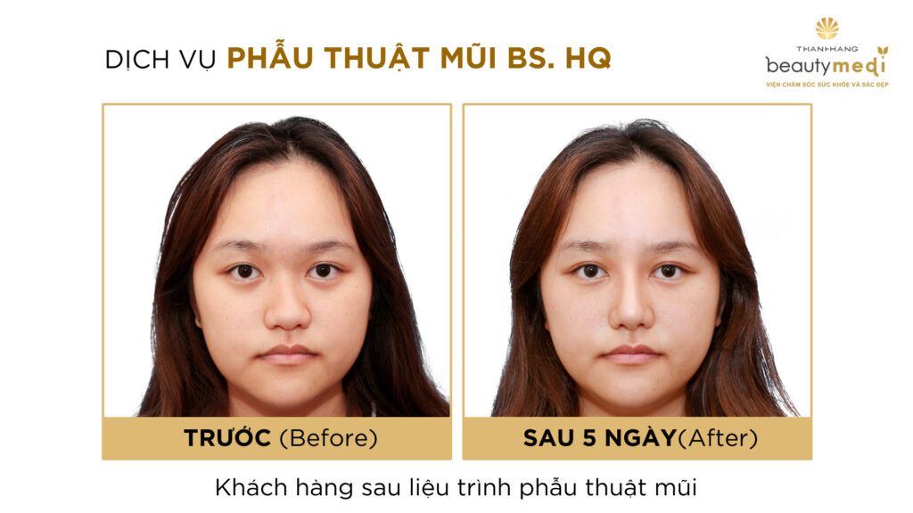 Hình ảnh khách hàng trước và sau phẫu thuật