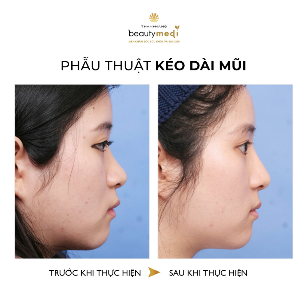 Hình ảnh trước và sau khi nâng mũi của khách hàng tại Thanh Hằng Beauty Medi