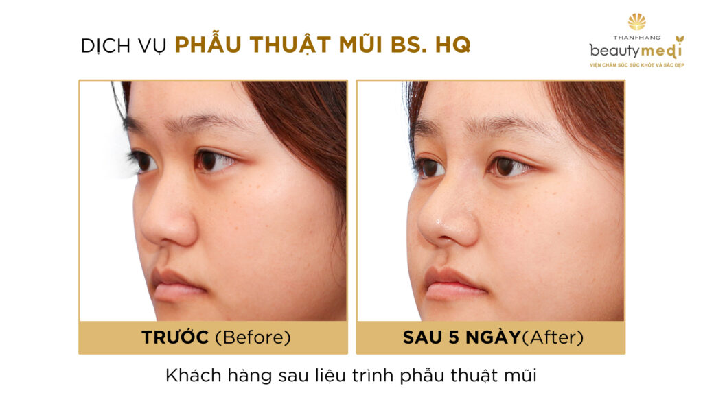 Hình ảnh trước và sau khi nâng mũi của khách hàng tại Thanh Hằng Beauty Medi