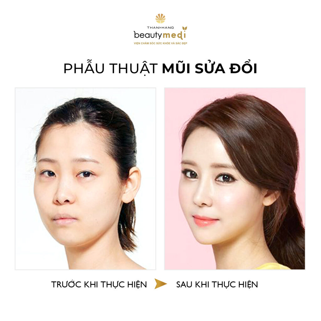 Hình ảnh trước và sau khi nâng mũi của khách hàng tại Thanh Hằng Beauty Medi