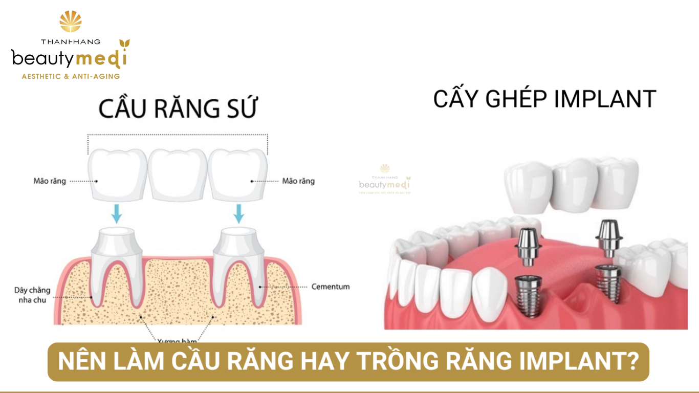 nên làm cầu răng hay cấy ghép implant thumbnail