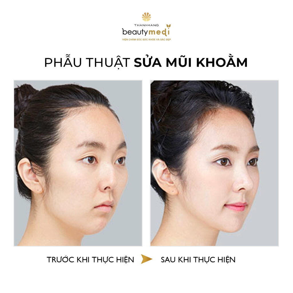 Hình ảnh những khách hàng đã trải nghiệm quy trình nâng mũi tại Thanh Hằng Beauty Medi