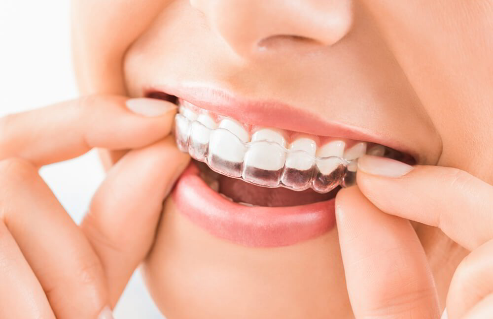 Bọc răng sứ cần kết hợp niềng răng nếu các vấn đề về khớp cắn chưa được giải quyết 
