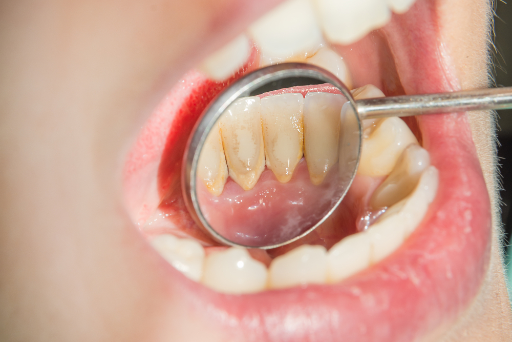 Răng sứ bị xỉn màu do nhiều nguyên nhân khác nhau