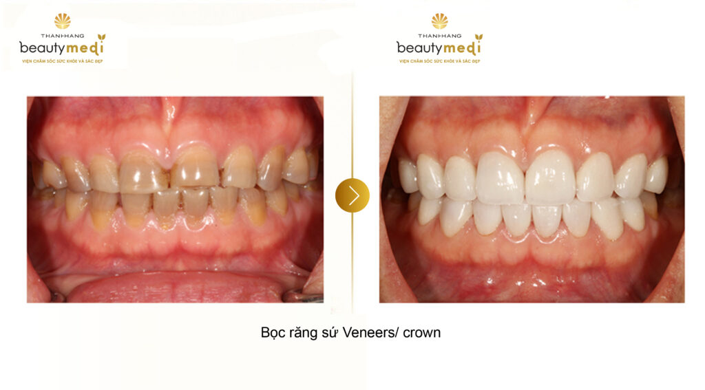 Hình ảnh thực tế của khách hàng trước và sau khi sử dụng dịch vụ bọc răng sứ Crown tại Thanh Hằng Beauty Medi