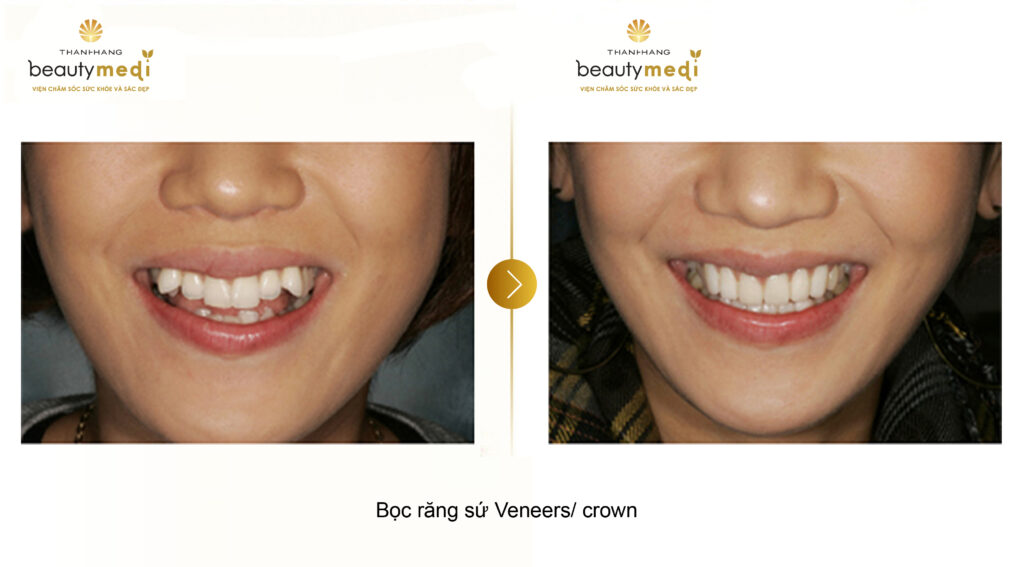 Hình ảnh thực tế của khách hàng trước và sau khi sử dụng dịch vụ bọc răng sứ Crown tại Thanh Hằng Beauty Medi