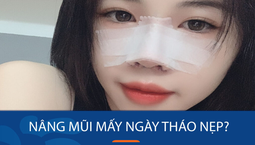 Nâng mũi có thể tháo nẹp sau 3-4 ngày nếu cơ địa tốt