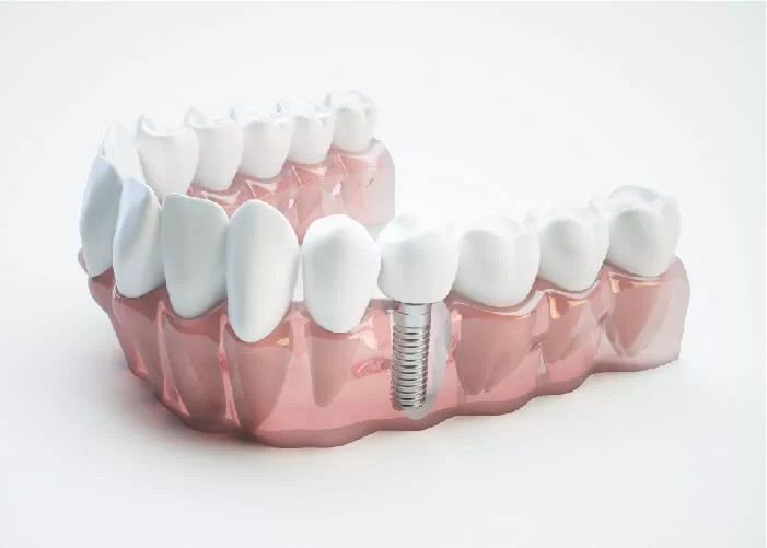 trồng răng implant là gì