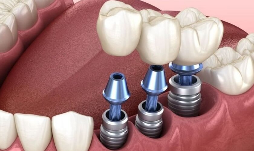 Trồng răng implant là gì