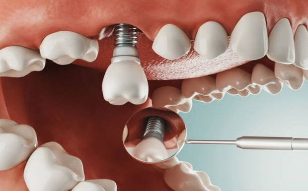 Vấn đề thời gian liên quan đến trồng răng Implant cũng được nhiều người quan tâm