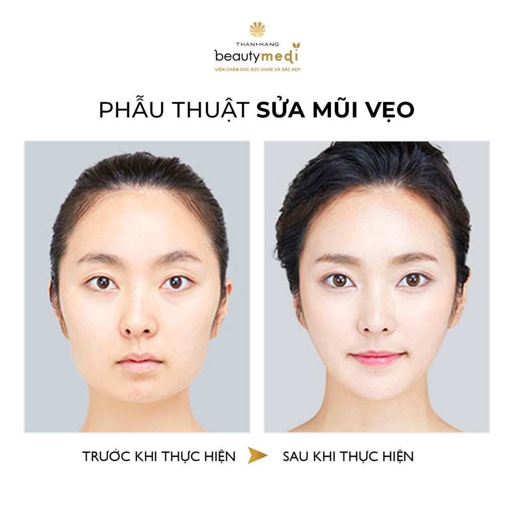Trước và sau khi thực hiện nâng mũi S-line
