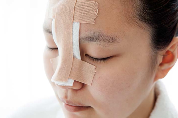 Nâng mũi bằng công nghệ tiên tiến để có được tướng mũi giàu sang
