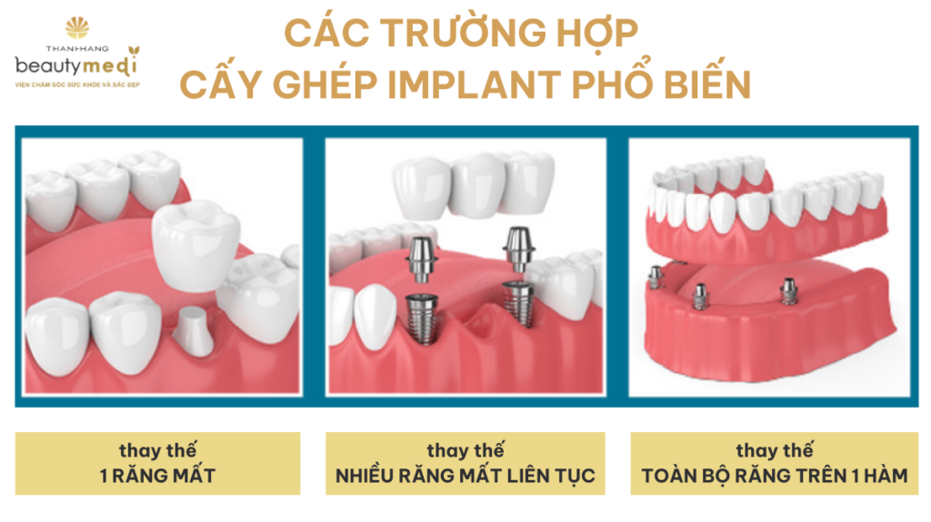 Các trường hợp cấy ghép Implant phổ biến