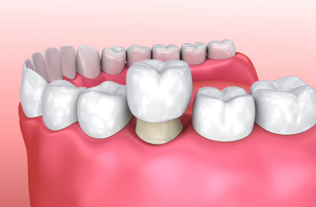 Bọc răng sứ có đau không phụ thuộc vào tay nghề bác sĩ 