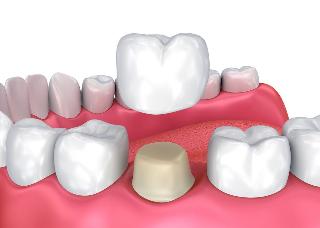 Quá trình bọc răng sứ chỉ tác động lên phần cứng của răng nên không gây chảy máu