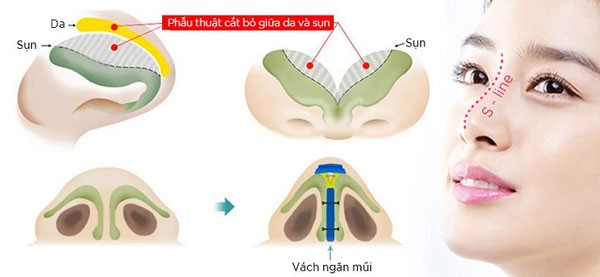 Bác sĩ sẽ dùng một phần sụn vách ngăn để dựng trụ, tạo dáng mũi đẹp tự nhiên, cân đố