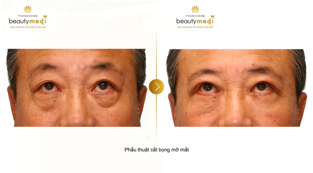 Hình ảnh trước và sau khi phẫu thuật cắt bọng mỡ mắt tại Thanh Hằng Beauty Medi 2