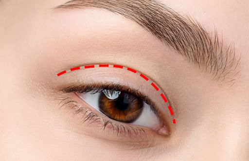 Câu hỏi Cắt mí mắt có được vĩnh viễn không