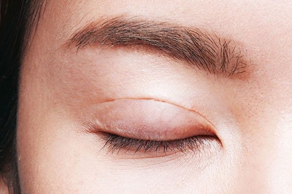 Cắt mí mắt có được vĩnh viễn không