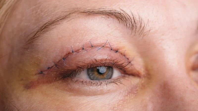 Ảnh hưởng của cắt mí mắt khi về già chịu ảnh hưởng của nhiều yếu tố