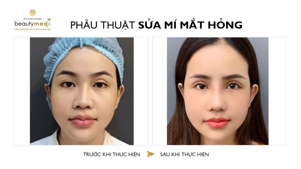 Hình ảnh trước và sau khi phẫu thuật của khách hàng tại Thanh Hằng Beauty Medi 