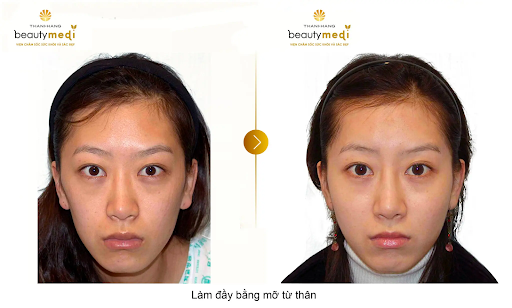 Hình ảnh trước và sau khi phẫu thuật của khách hàng tại Thanh Hằng Beauty Medi 