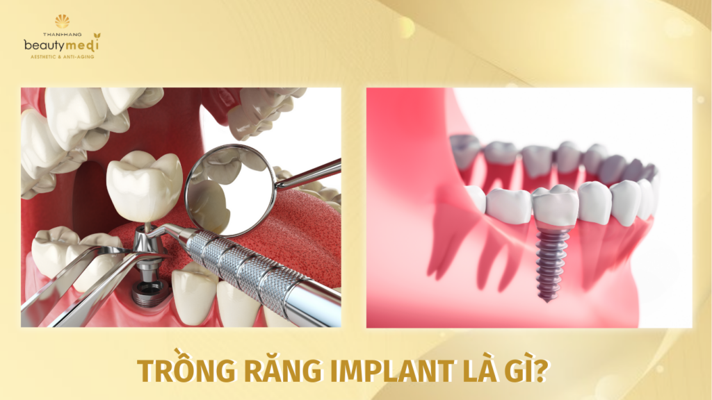 trồng răng implant là gì