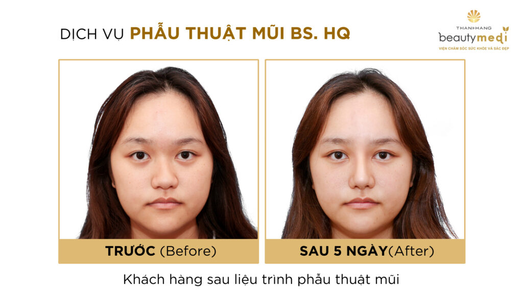 Hình ảnh trước và sau khi phẫu thuật của khách hàng tại Thanh Hằng Beauty Medi