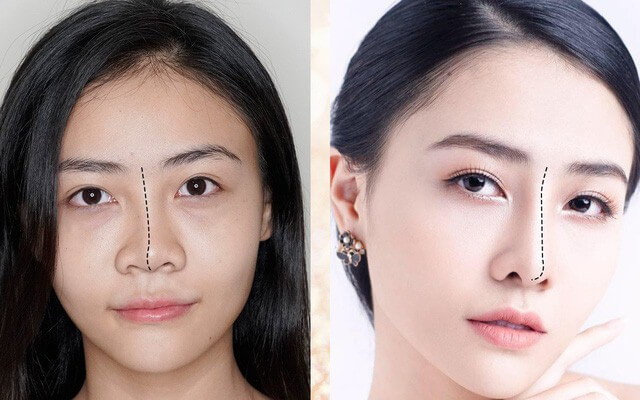 Phẫu thuật thẩm mỹ sẽ giúp bạn sở hữu chiếc mũi tài lộc 