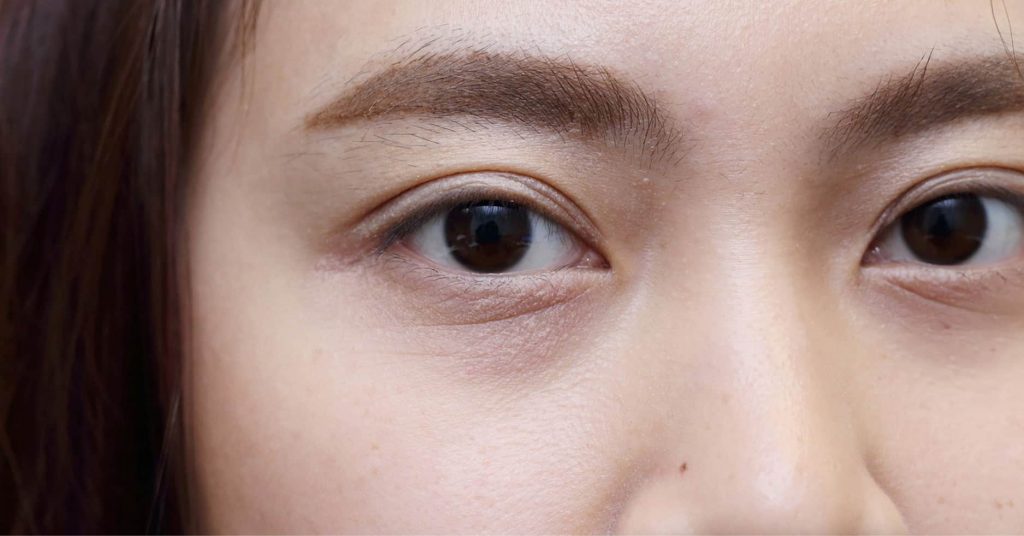 Hốc mắt sâu khiến mắt trông già nua và thiếu sức sống 