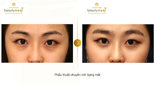 Hình ảnh khách hàng trước và sau khi phẫu thuật chuyển mỡ bọng mắt