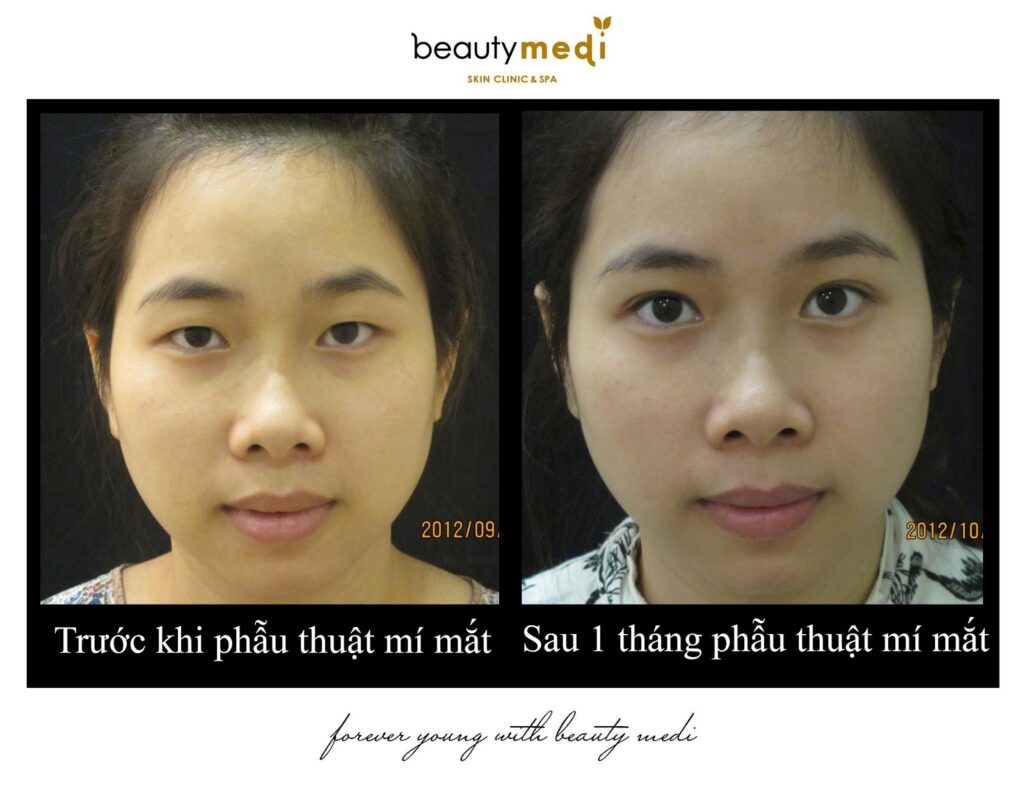 Thần thái thay đổi rõ rệt sau khi tiến hành cắt mí ở Thanh Hằng Beauty Medi 