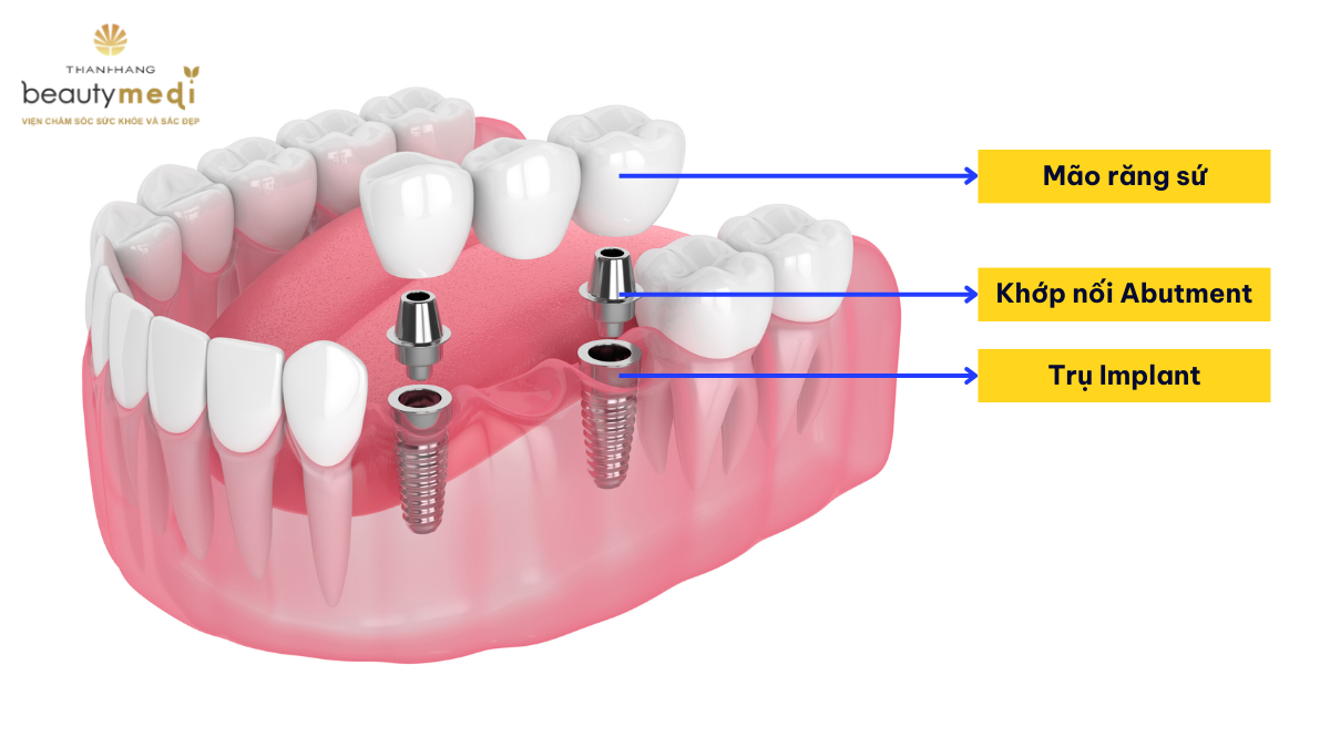 Cấu tạo răng Implant