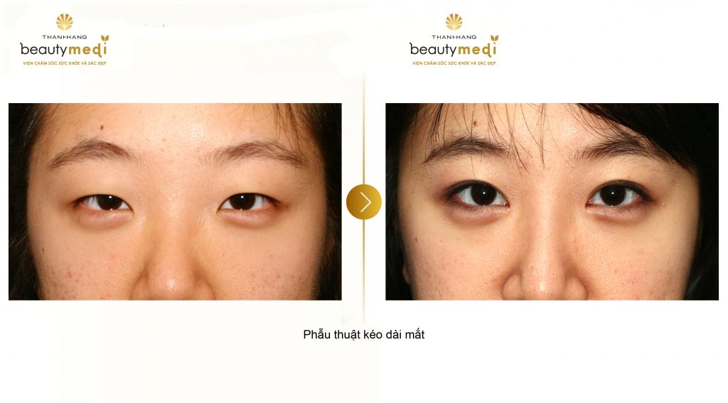 Hình ảnh trước và sau khi phẫu thuật kéo dài mắt