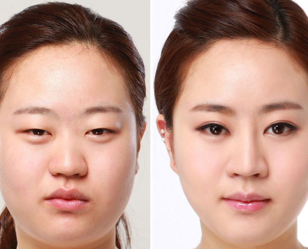 Chăm sóc mắt sau hậu phẫu cắt mí mắt cực kỳ quan trọng