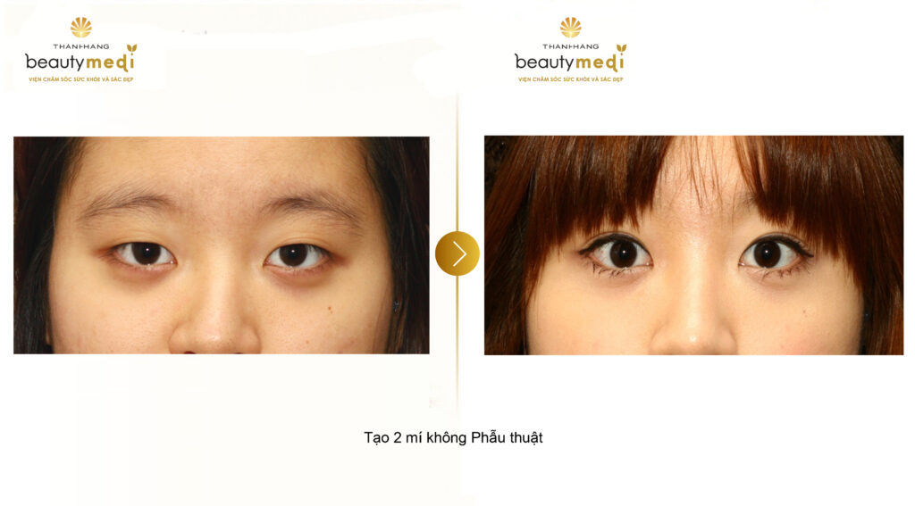 Hình ảnh khách hàng trước và sau khi cắt mí mắt tại Thanh Hằng Beauty Medi 