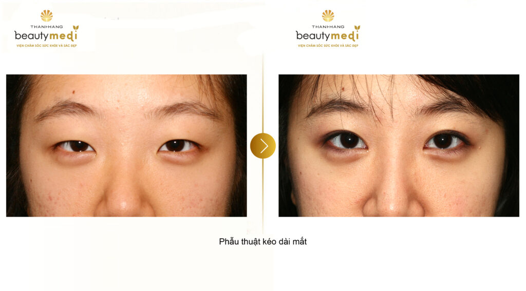 khách hàng trước và sau khi trải nghiệm dịch vụ phẫu thuật kéo dài mắt