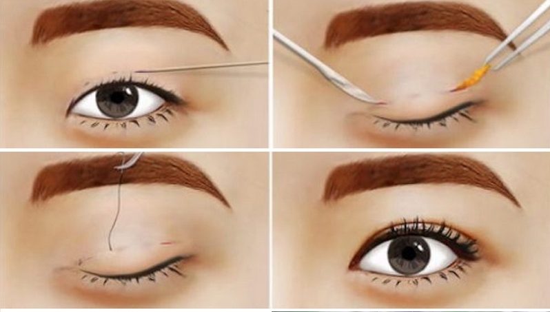Nhấn mí mắt là phẫu thuật đơn giản giúp đôi mắt to tròn hơn